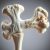 Osteoporoza: przyczyny, objawy i metody zapobiegania