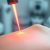 Laseroterapia punktowa: jak działa i jakie ma efekty?